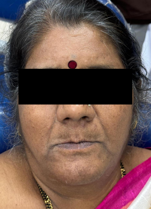 Implant supported upper and lower dentures before treatment