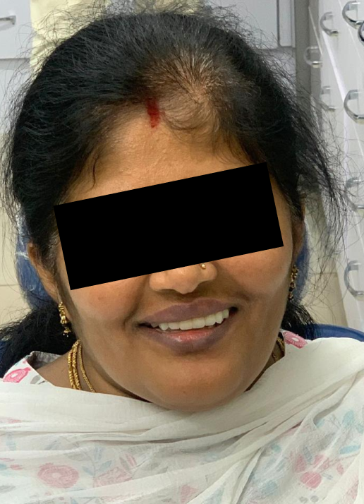 Implant supported upper and lower dentures after treatment