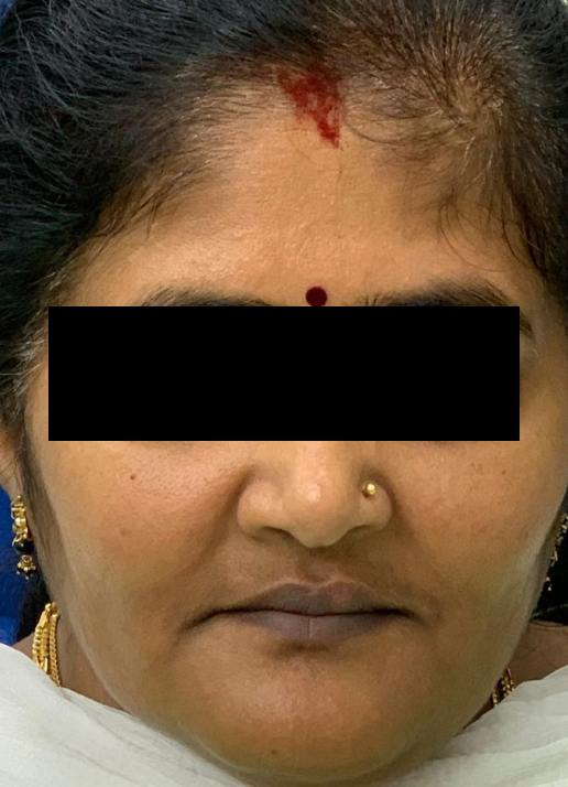 Implant supported upper and lower dentures after treatment