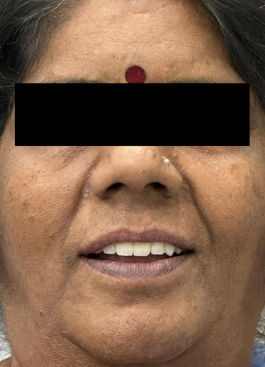 Implant supported upper and lower dentures after treatment