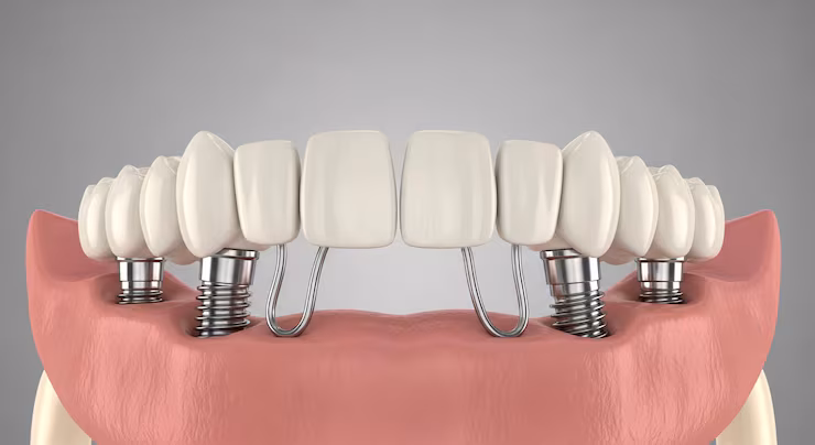 All On 4 Dental Implants in Bangalore - Full Arch Restoration