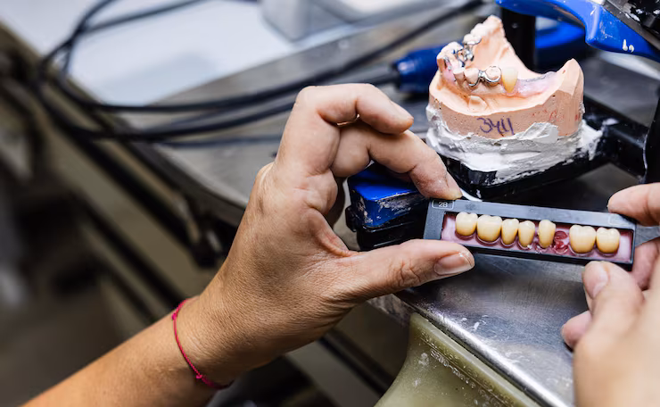 Hybrid Prosthesis in Bangalore - Fixed Full Arch Implant Solution