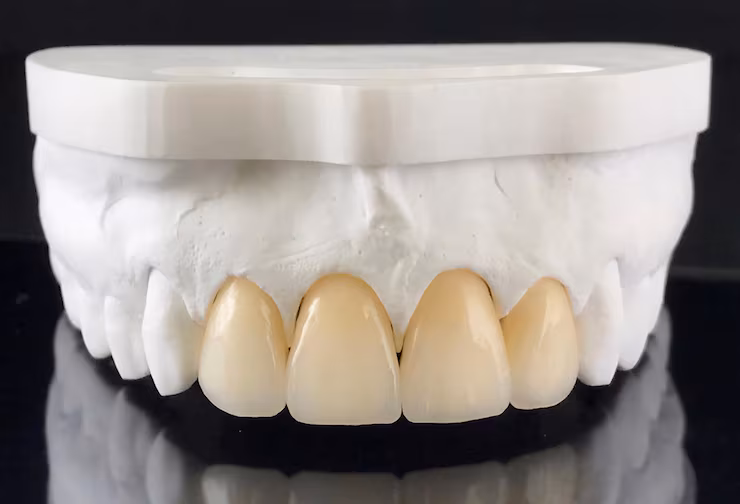 Zirconia / Porcelain Crowns in Bangalore - Strong & Natural Looking Dental Restorations
